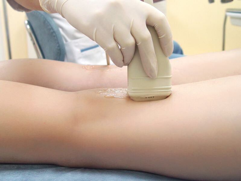 Tratamento de varices