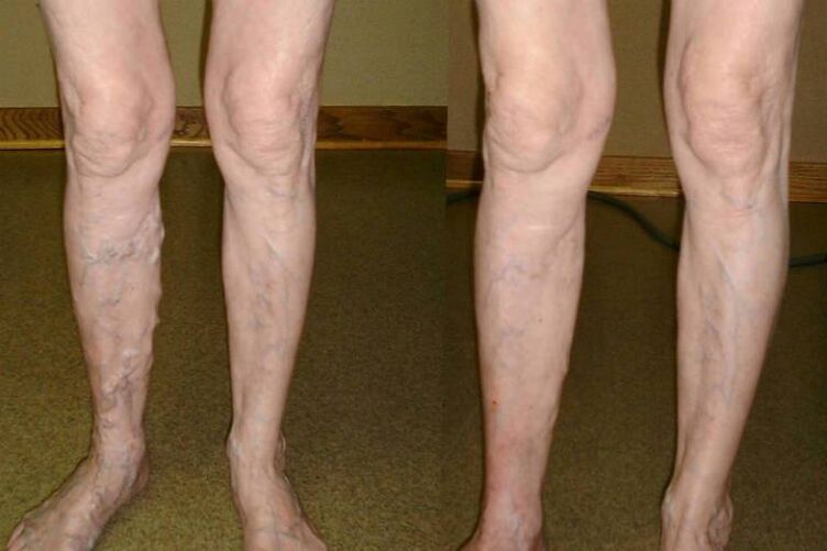 Varices en homes