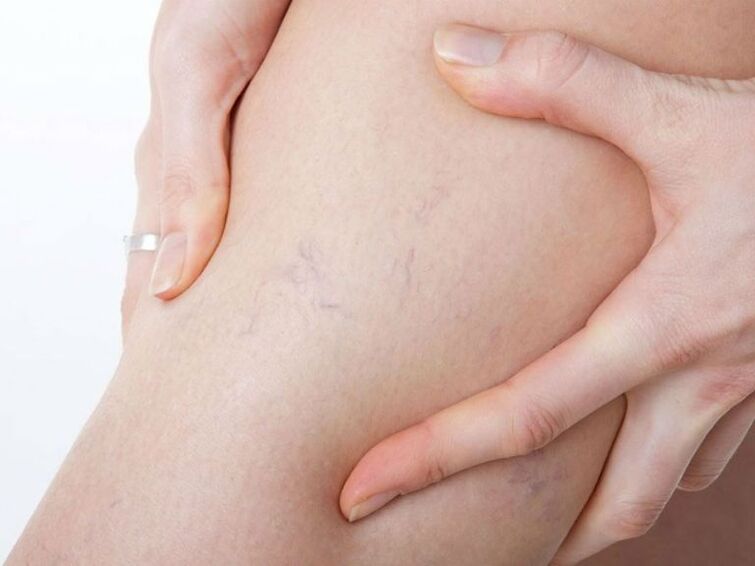 Varices nas pernas