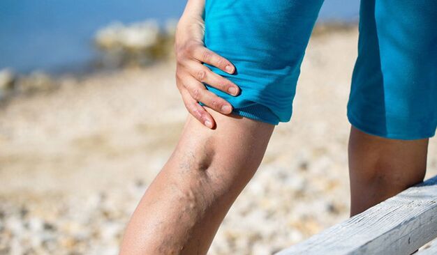 Varices