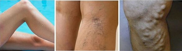 A aparición de varices nos pés