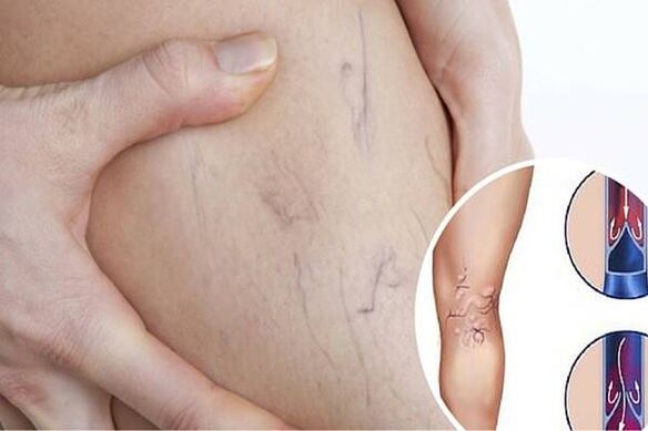 Varices Veinas Foto