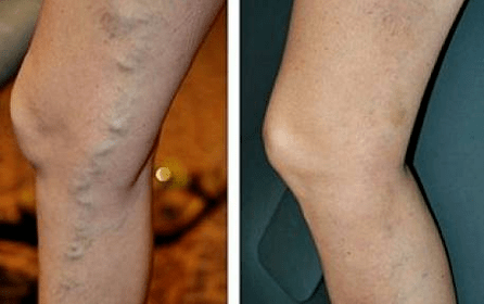 Varices vas antes e despois